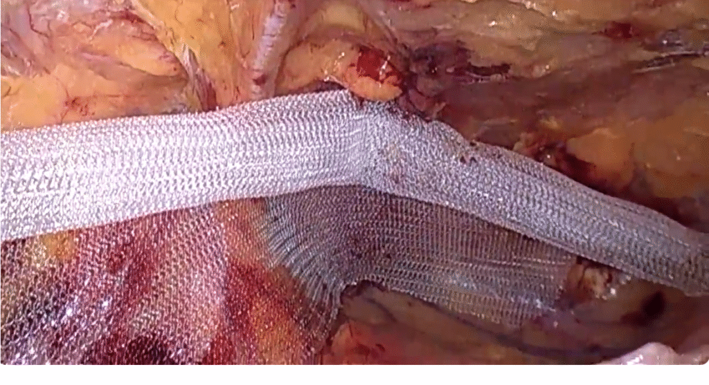 Tela na hérnia inguinal