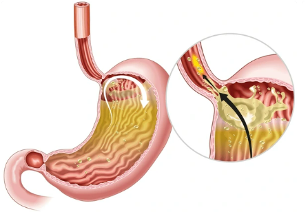 hérnia de hiato retorno ácido