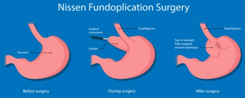 cirurgia de nissen na hernia de hiato