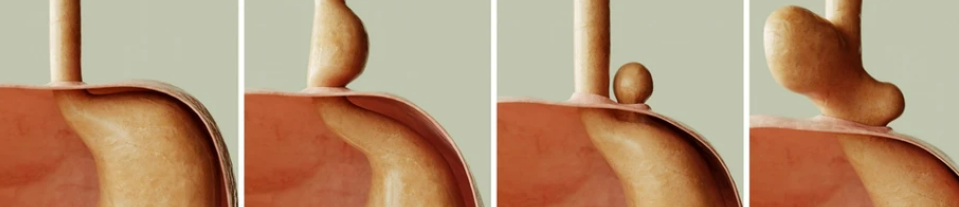 tipos de hernia de hiato