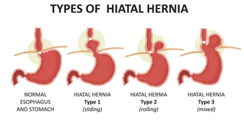tipos de hérnia de hiato