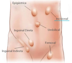 HÉRNIAS DA PAREDE ABDOMINAL