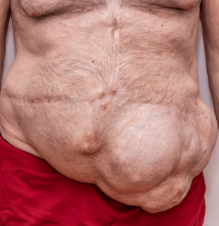 hérnia incisional de cicatriz