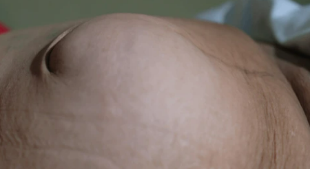 hérnia incisional de cicatriz mediana